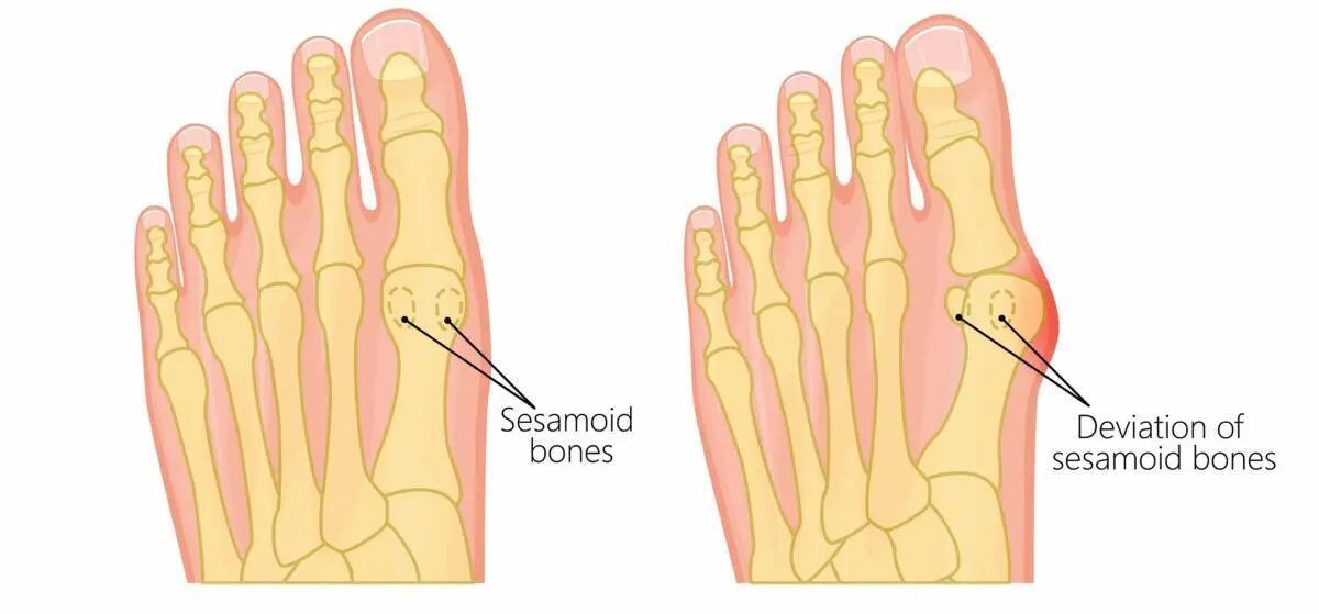 Is Sesamoiditis serious? - Becker's Best Shoes