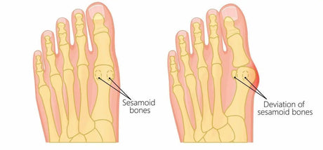 Is Sesamoiditis serious?