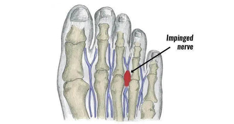 Morton’s Neuroma"?