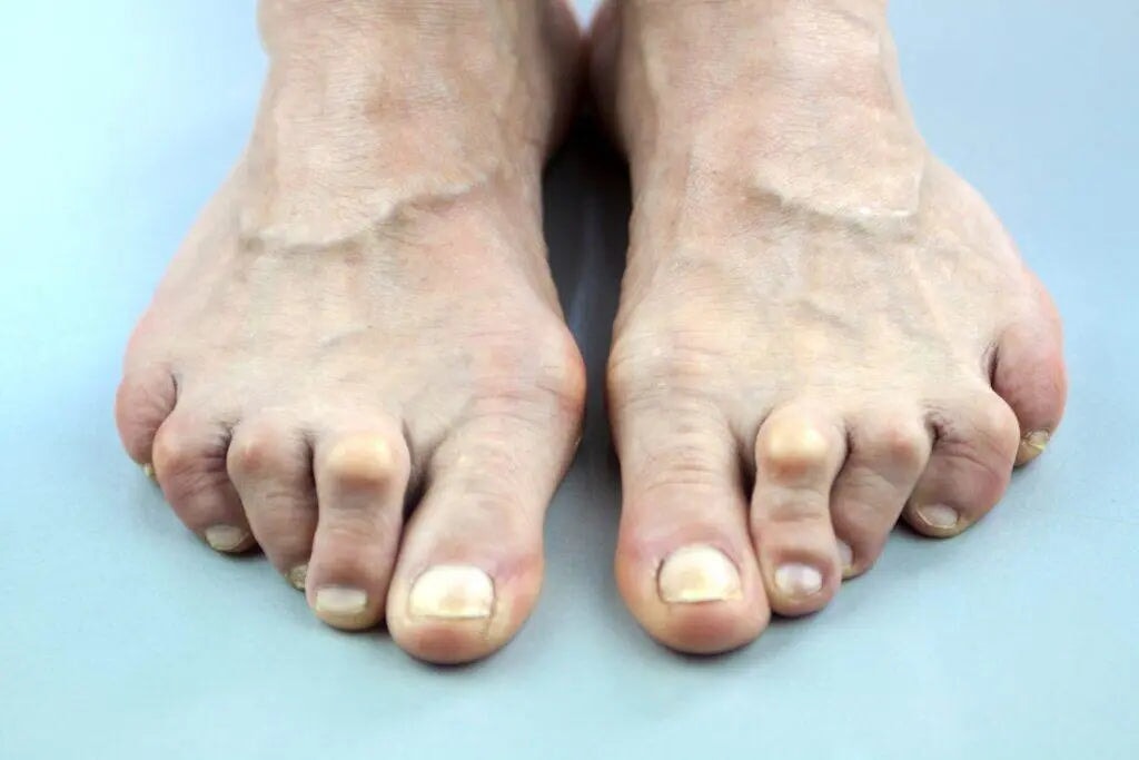 So I think I have a "Mallet or Hammer Toe"...